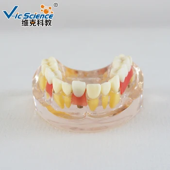 Implantát Demonstrační Model Půl úst zubní implantát model