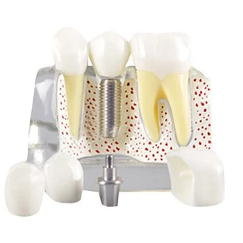 Zuby Demonstrační Model Implantátu Vyměnitelné Analýzy Korunu Most -Pacient Komunikace